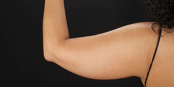 Liposuction Before & After Patient #1482