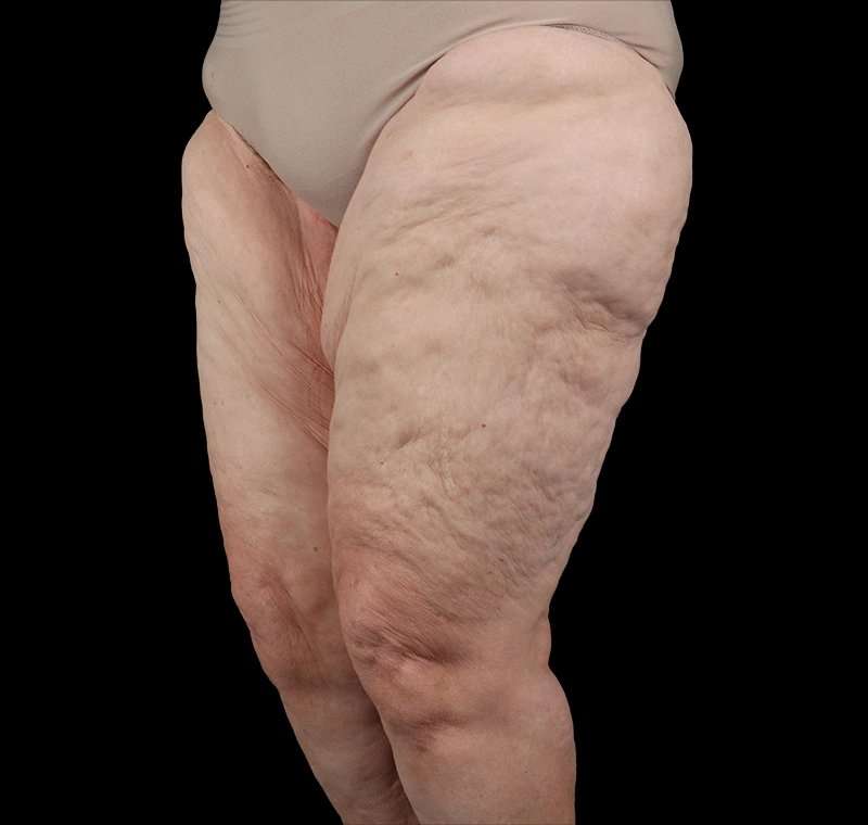 Liposuction Before & After Patient #1495