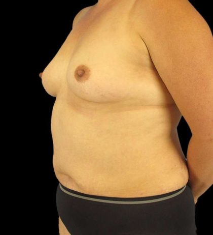 Mommy Makeover Before & After Patient #1547