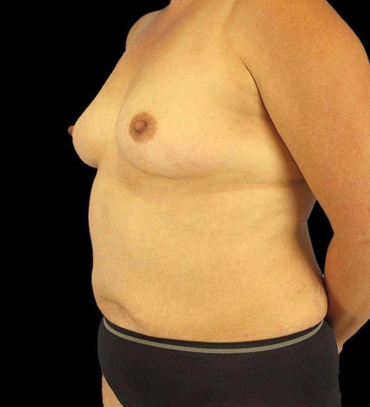 Mommy Makeover Before & After Patient #1547
