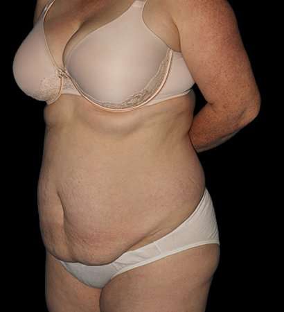 Abdominoplasty (Tummy Tuck) Before & After Patient #625