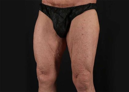 Thigh Lift Before & After Patient #1776