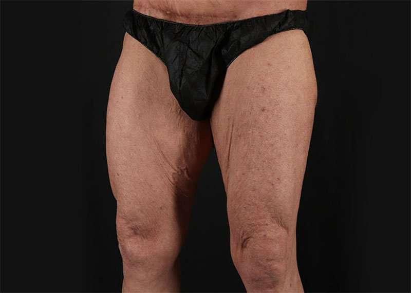 Thigh Lift Before & After Patient #1776