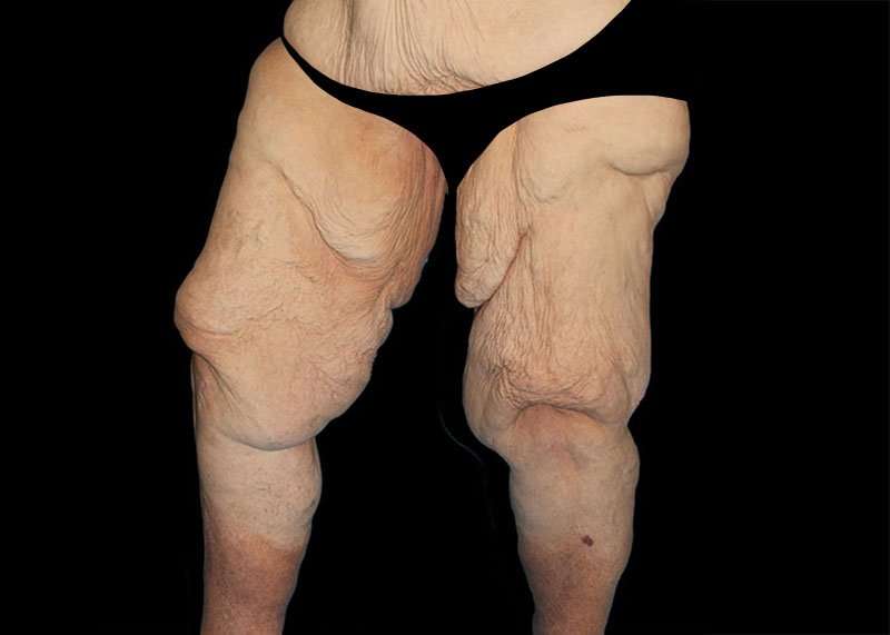 Thigh Lift Before & After Patient #1790
