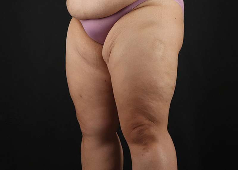 Thigh Lift Before & After Patient #1804