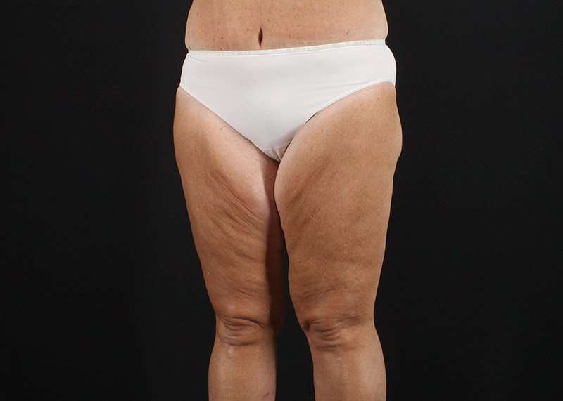 Thigh Lift Before & After Patient #1818