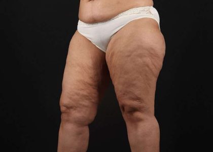 Thigh Lift Before & After Patient #1831