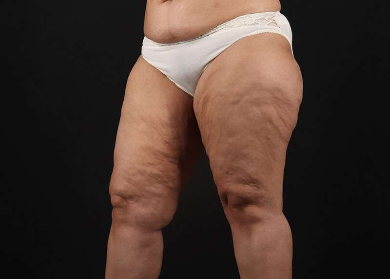 Thigh Lift Before & After Patient #1831