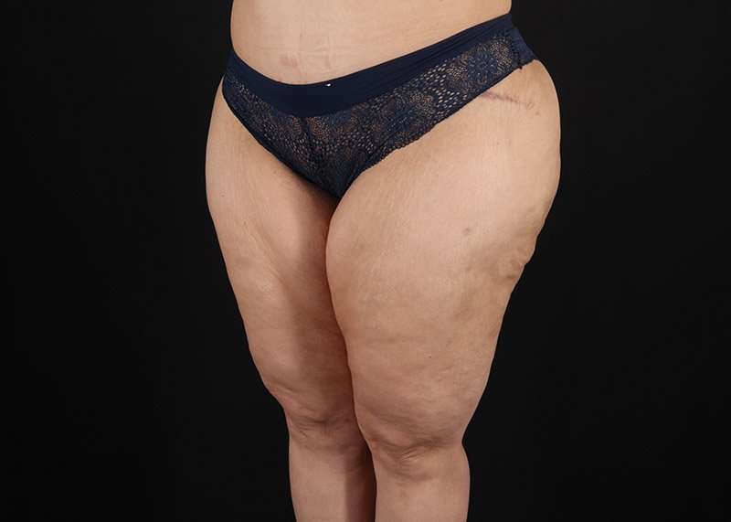 Thigh Lift Before & After Patient #1844