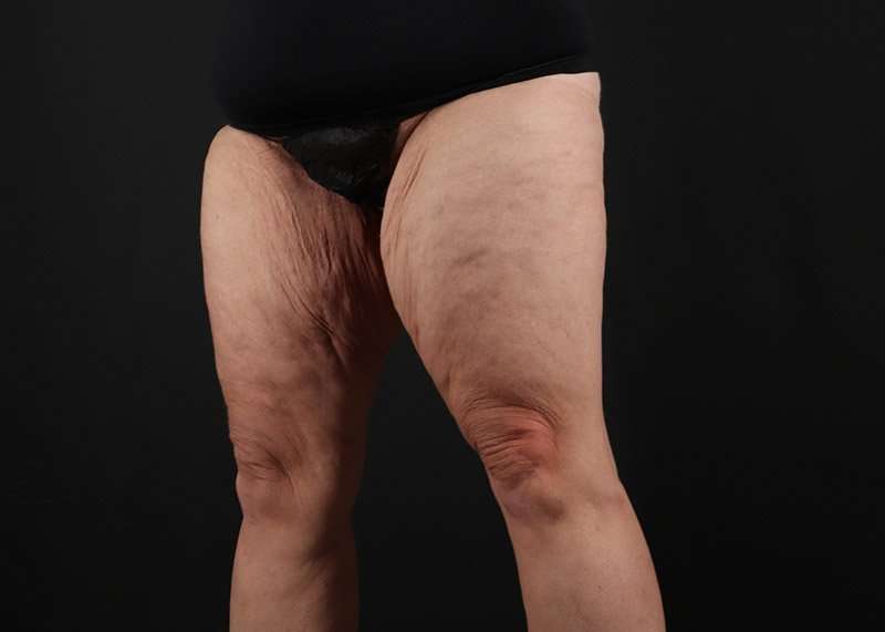 Thigh Lift Before & After Patient #1857