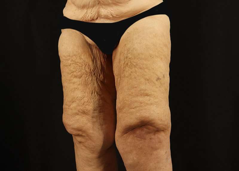 Thigh Lift Before & After Patient #1871