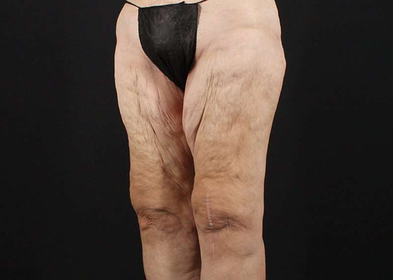 Thigh Lift Before & After Patient #1884
