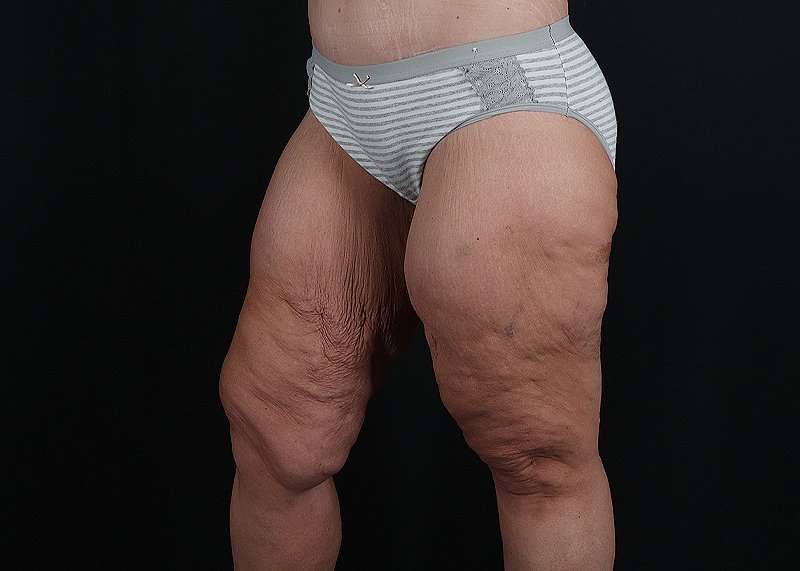 Thigh Lift Before & After Patient #1897