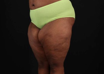 Thigh Lift Before & After Patient #1911