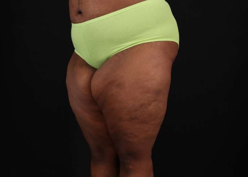 Thigh Lift Before & After Patient #1911