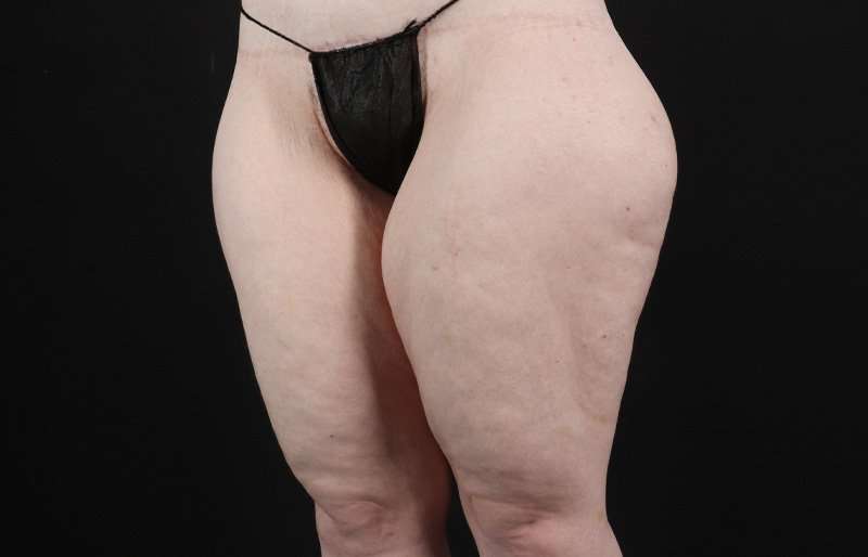 Thigh Lift Before & After Patient #1925
