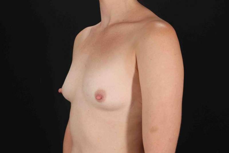 Breast Augmentation w/ Fat Transfer Before & After Patient #2027