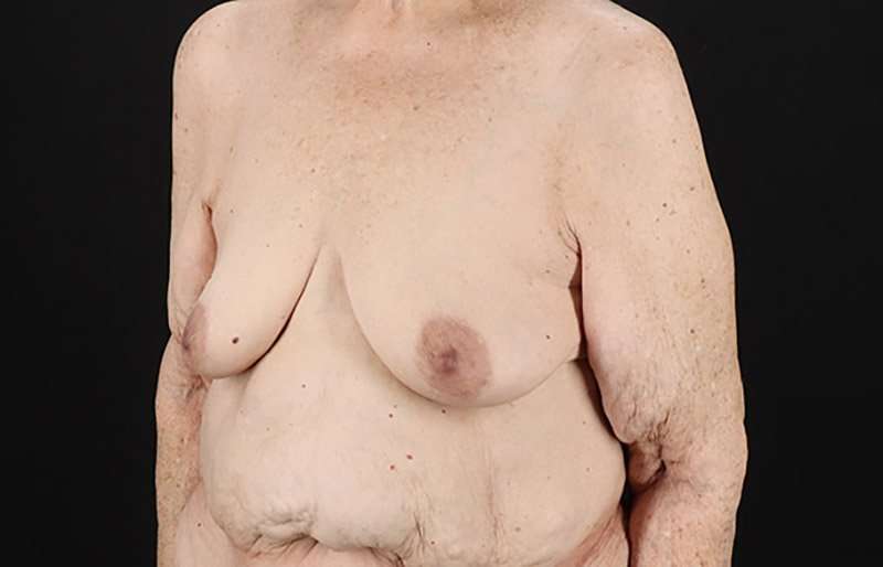 Breast Augmentation w/ Fat Transfer Before & After Patient #2049