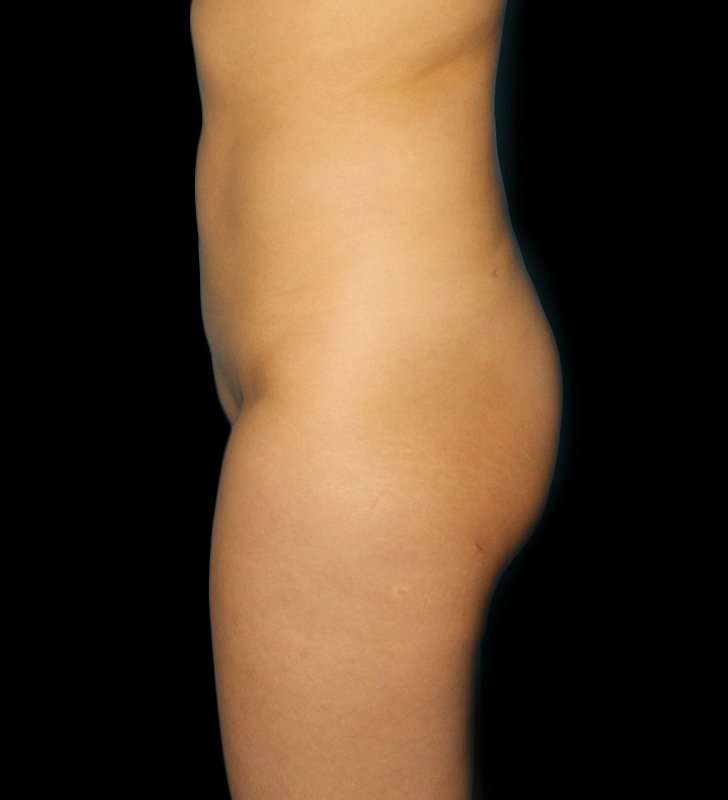 Brazilian Butt Lift Before & After Patient #557