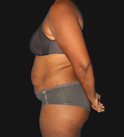 Abdominoplasty (Tummy Tuck) Before & After Patient #568