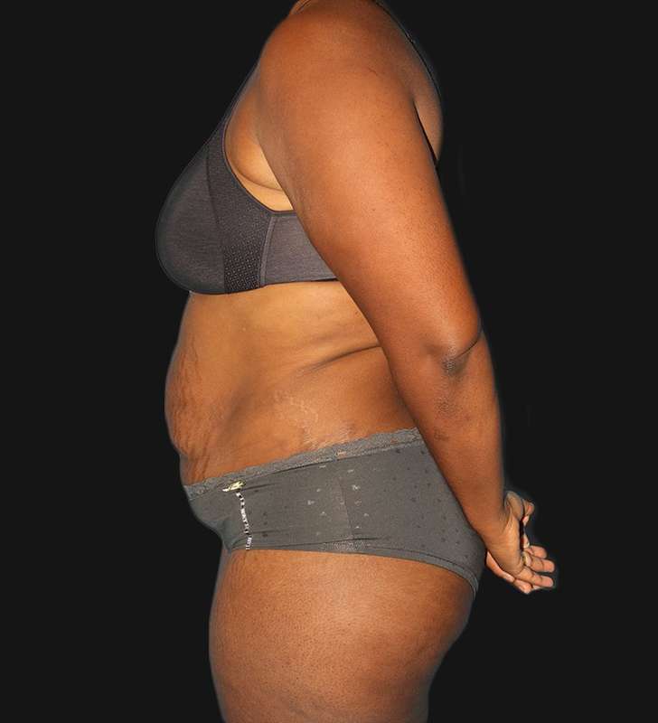 Abdominoplasty (Tummy Tuck) Before & After Patient #568