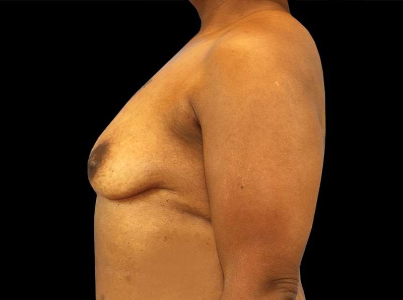 Breast Augmentation Before & After Patient #2121