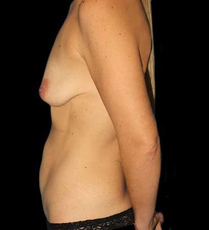 Breast Augmentation Before & After Patient #2147