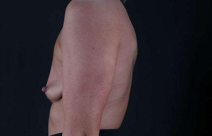Breast Augmentation Before & After Patient #2281
