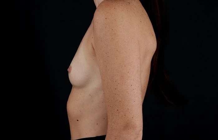 Breast Augmentation Before & After Patient #2365