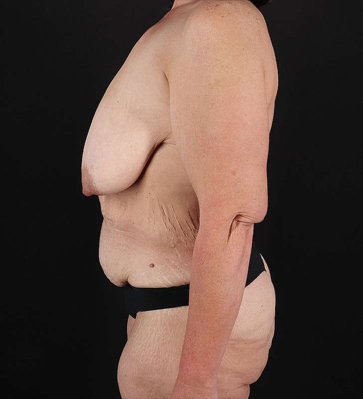 Breast Augmentation Before & After Patient #2389