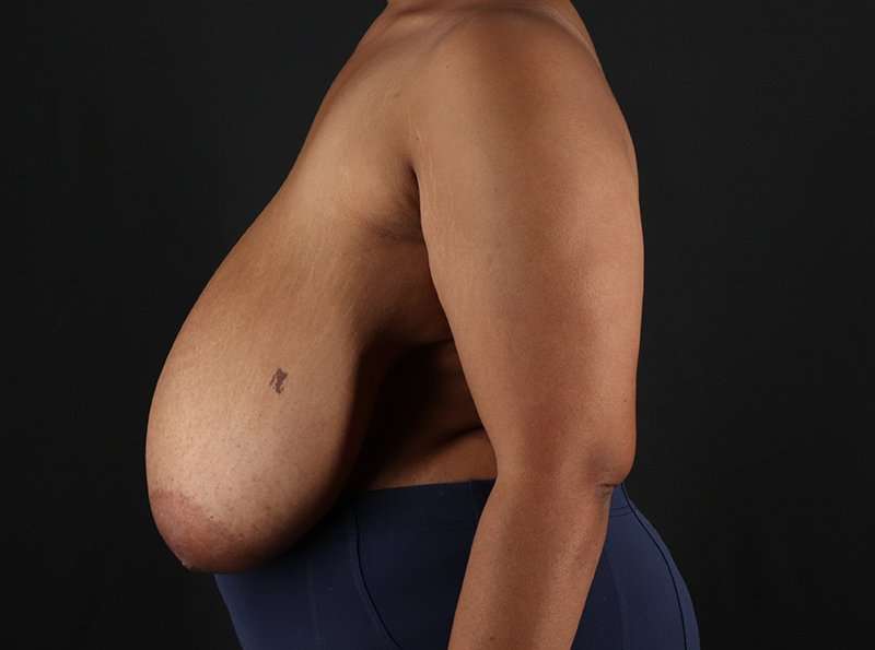 Breast Reduction Before & After Patient #2463
