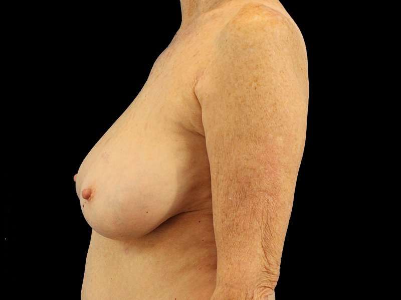 Breast Reduction Before & After Patient #2474