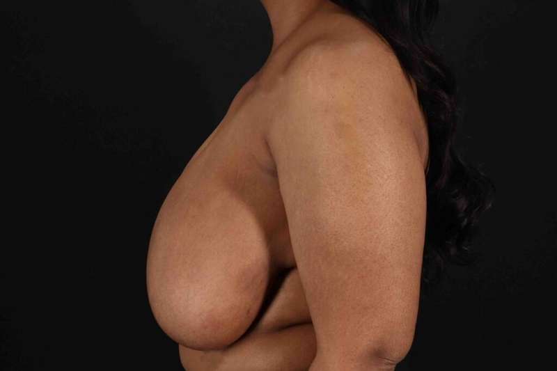 Breast Reduction Before & After Patient #2580