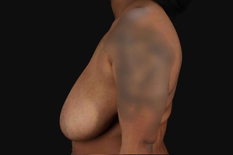 Breast Reduction Before & After Patient #2602