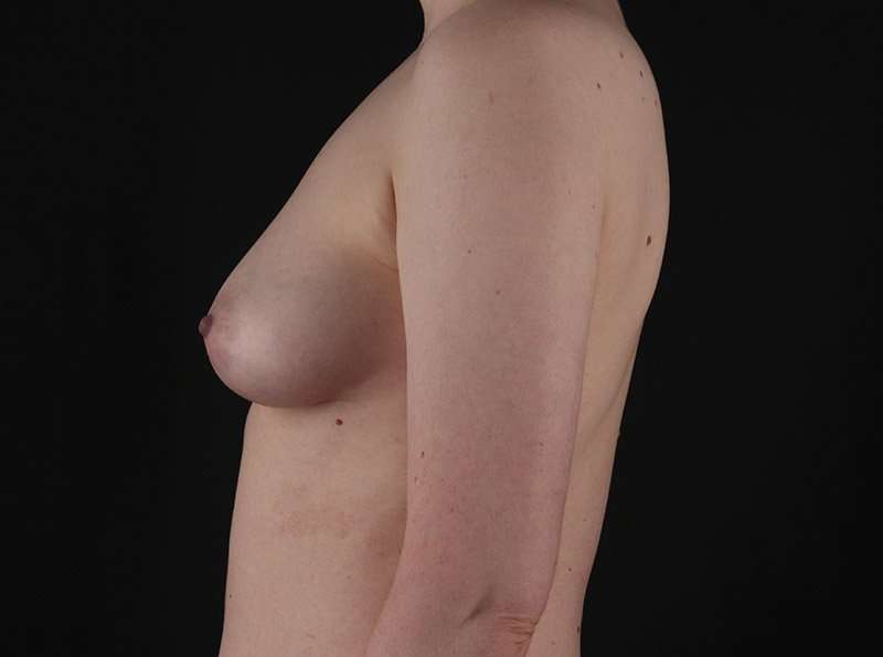 Breast Reduction Before & After Patient #2635