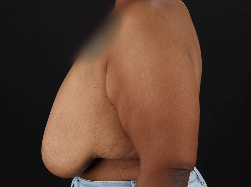 Breast Reduction Before & After Patient #2646