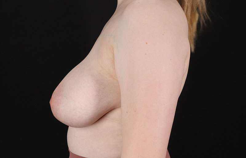 Breast Reduction Before & After Patient #2687