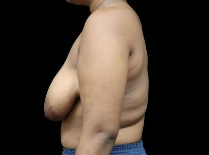 Breast Reduction Before & After Patient #2729
