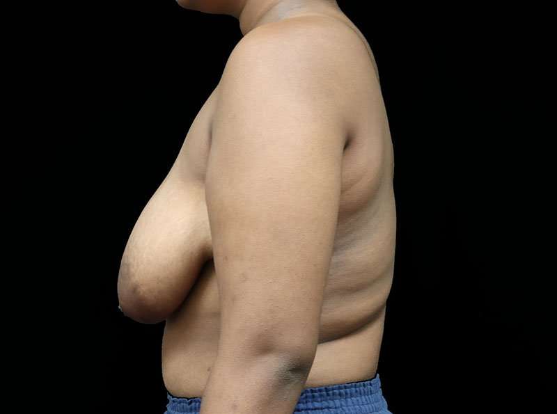 Breast Reduction Before & After Patient #2729