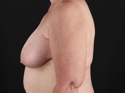 Breast Reduction Before & After Patient #2766