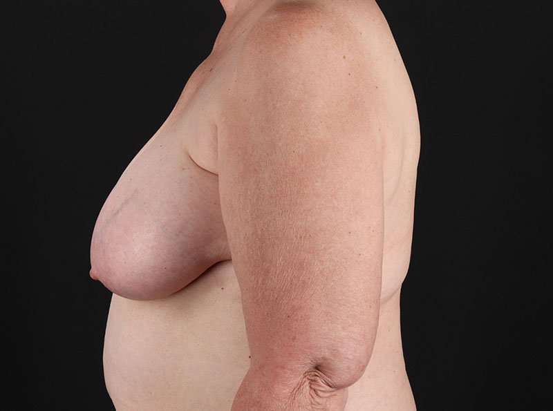 Breast Reduction Before & After Patient #2766