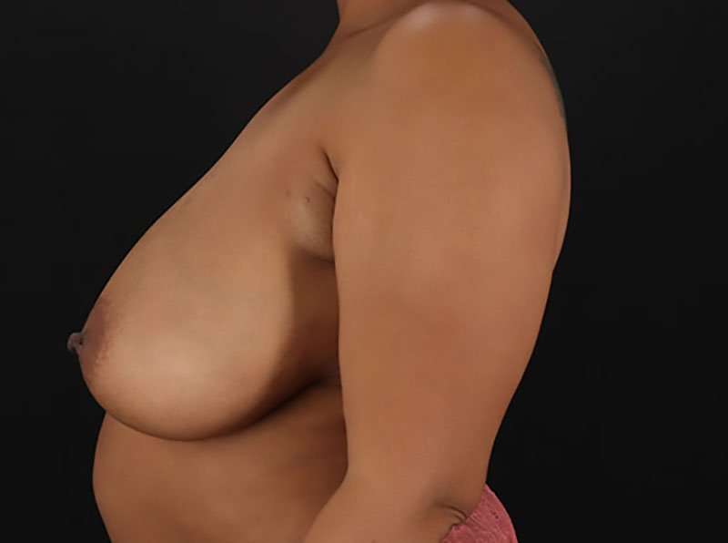 Breast Reduction Before & After Patient #2777