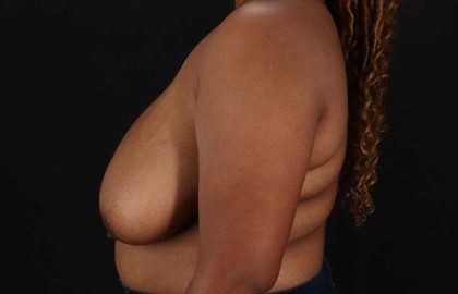 Breast Reduction Before & After Patient #2824