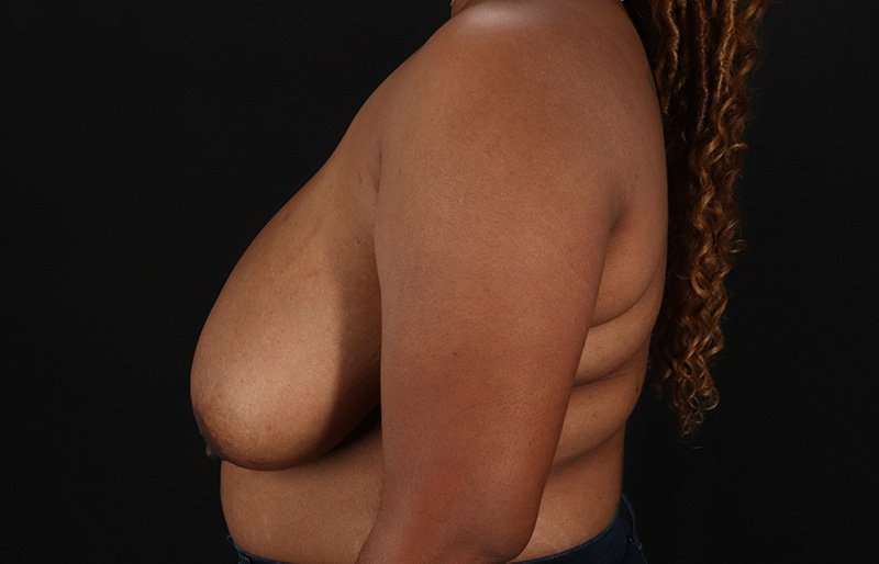 Breast Reduction Before & After Patient #2824