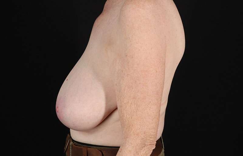 Breast Reduction Before & After Patient #2836
