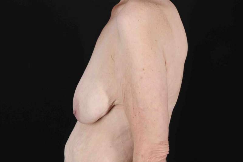 Breast Reduction Before & After Patient #2847