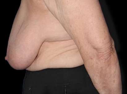 Breast Reduction Before & After Patient #2859