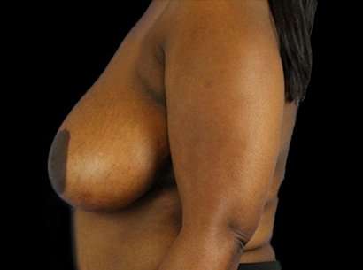 Breast Reduction Before & After Patient #2870