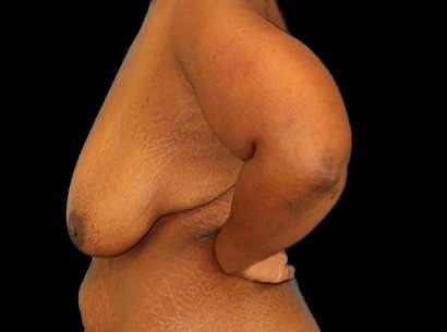 Breast Reduction Before & After Patient #2881