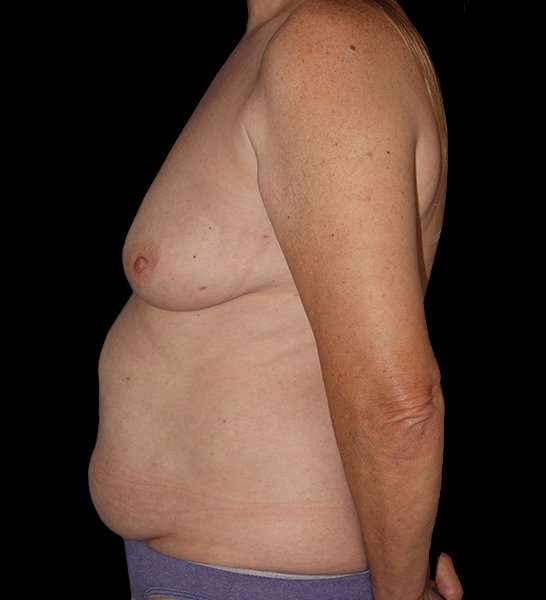 DIEP Flap Before & After Patient #2943